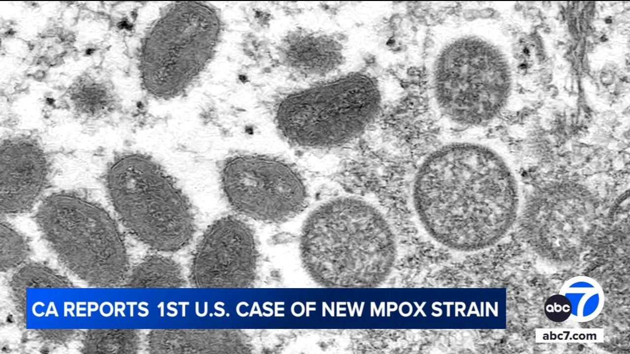 united-states’-first-known-case-of-more-severe-strain-of-mpox-is-confirmed-in-northern-california