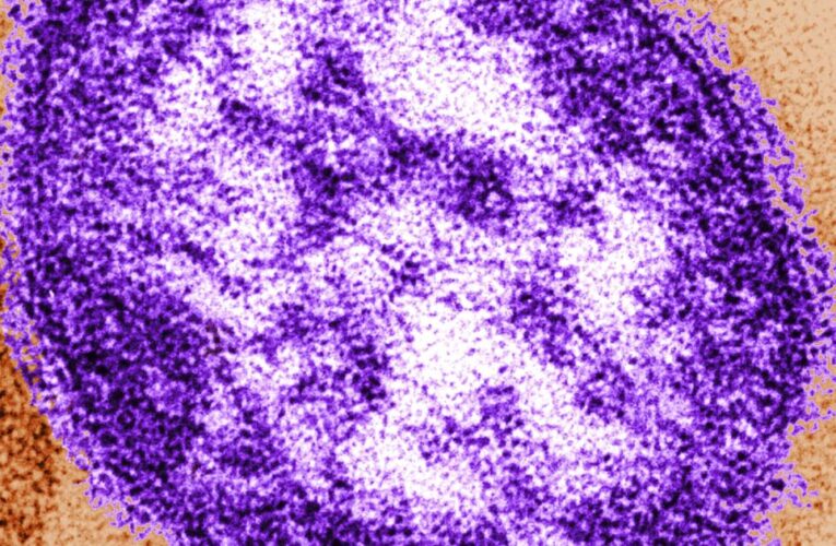 Measles case reported at LAX, Orange County children’s hospital. Who is at risk?