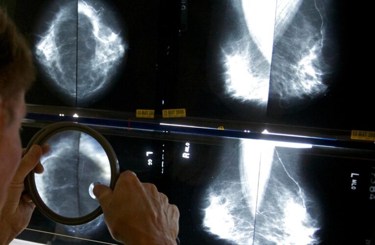 Some breast cancer patients can avoid certain surgeries, studies suggest