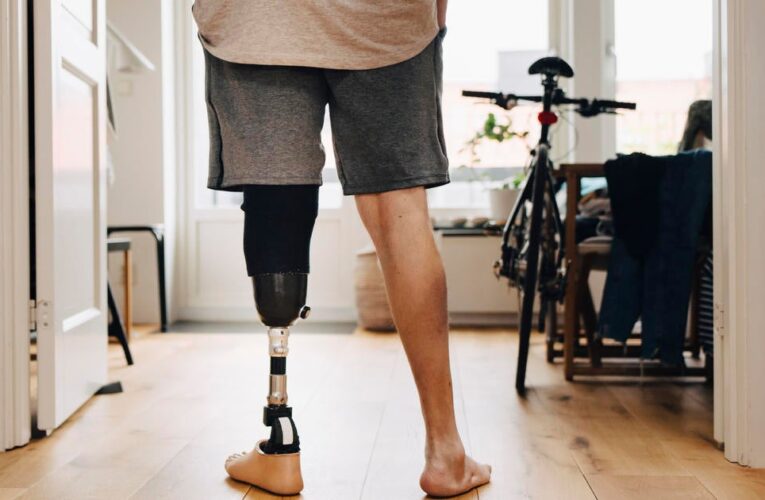 Health insurers limit coverage of prosthetic limbs