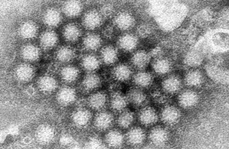 Nasty norovirus is back in full force with U.S. cases of the stomach virus surging